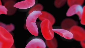 anemia-falciforme
