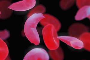 anemia-falciforme