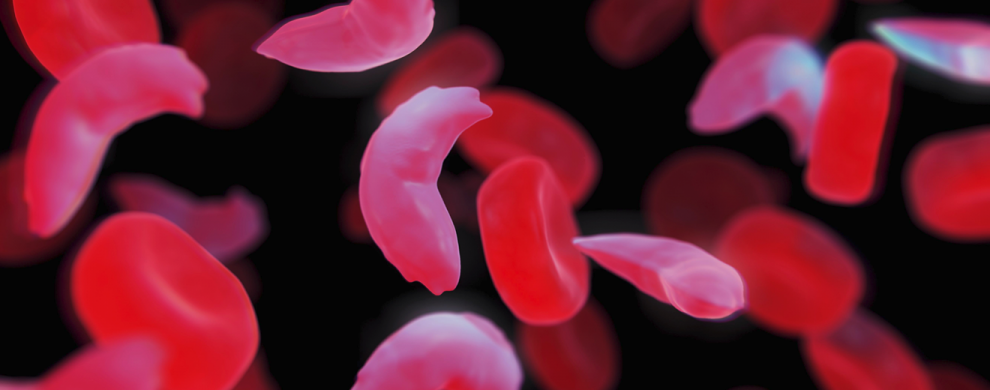 anemia-falciforme