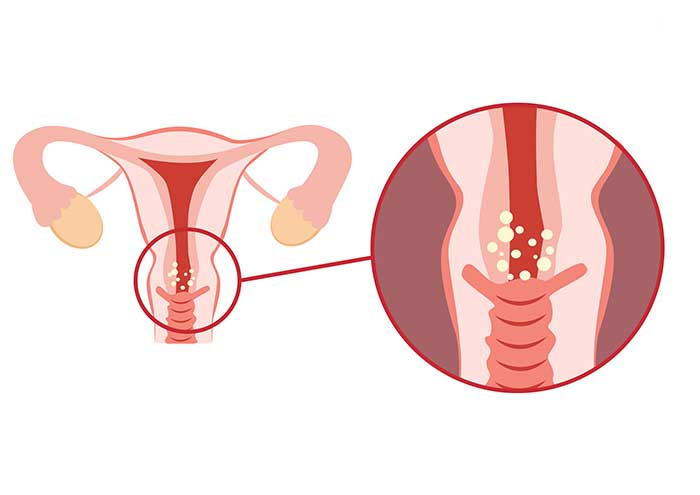 cancer-de-cuello-uterino